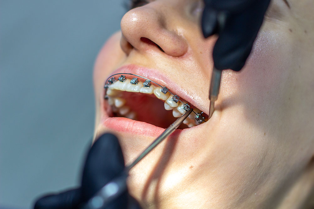 Eine Frau mit Zahnspangen besucht einen Kieferorthopäden in der Klinik auf einem Zahnarztstuhl. Dabei wird der Zahnspangenbogen an den Ober- und Unterzähnen angebracht. Der Zahnarzt trägt Handschuhe und hält zahnärztliche Instrumente in der Hand. Das Konzept der Zahnmedizin